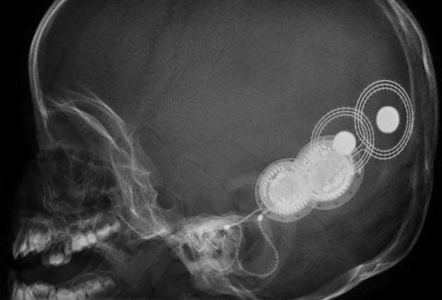 Radiografía de cráneo con detalle de un implante coclear