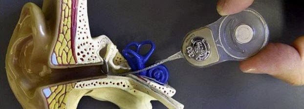 Prototipo de implante coclear conectado a una maqueta de prótesis